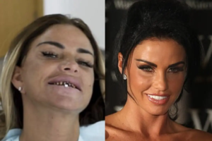 katie-price-teeth-before-after-02