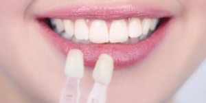 dental-veneers-for-missing-tooth
