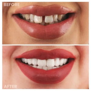 veneers-for-missing-teeth-before-after