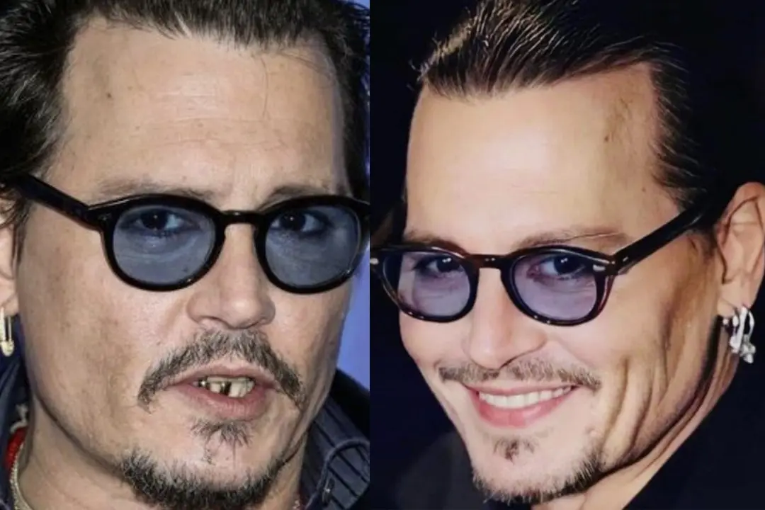 johnny-depp-teeth-before-after-05