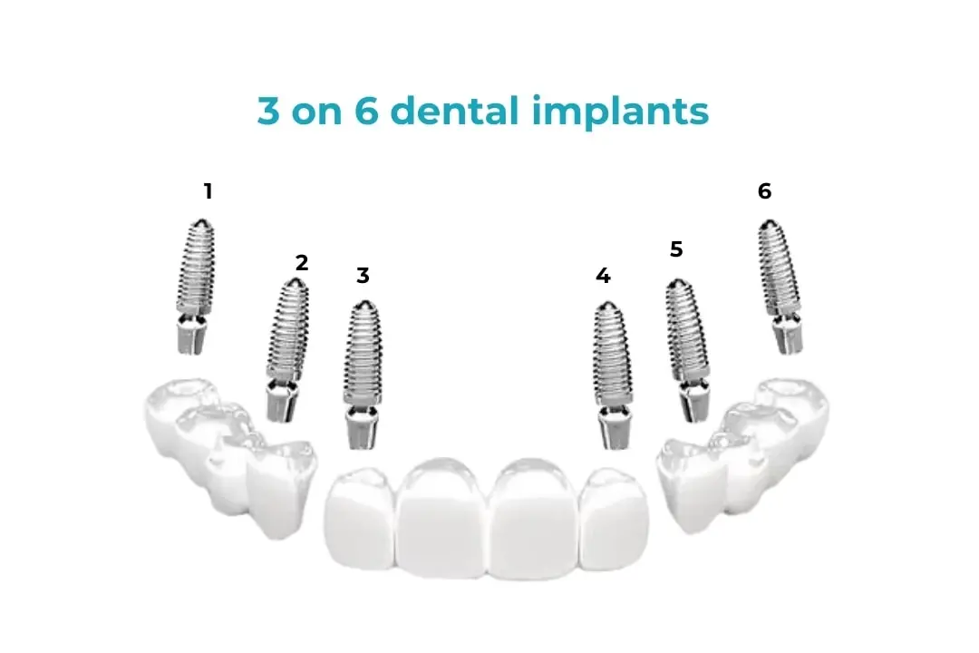 3-on-6 dental implants Antalya Turkey