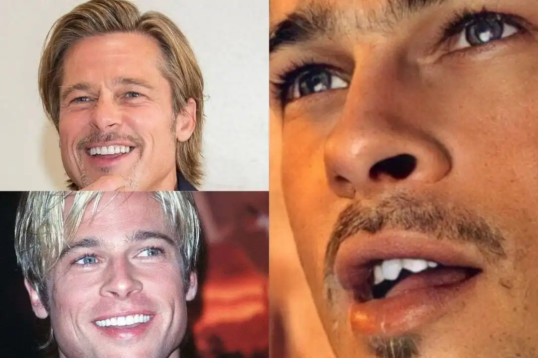 Brad Pitt teeth before after