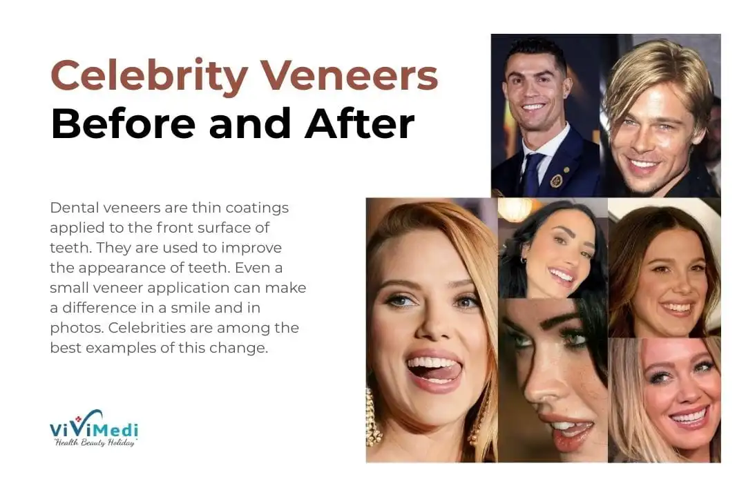 Celebrity Veneers Before and After