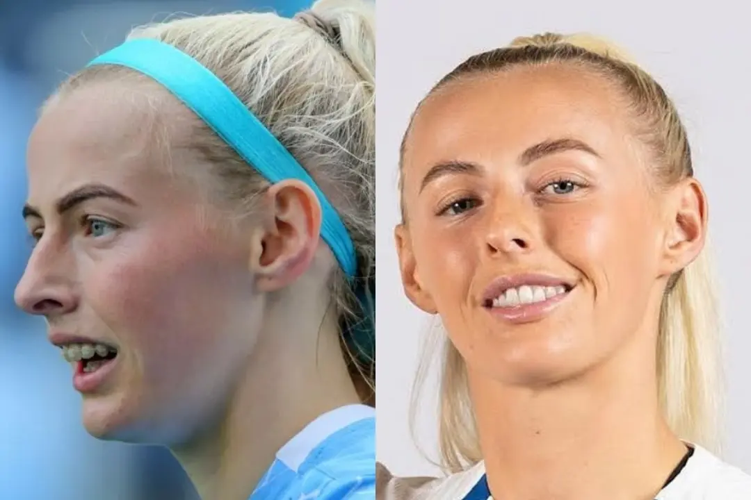 Chloe Kelly's teeth before and after