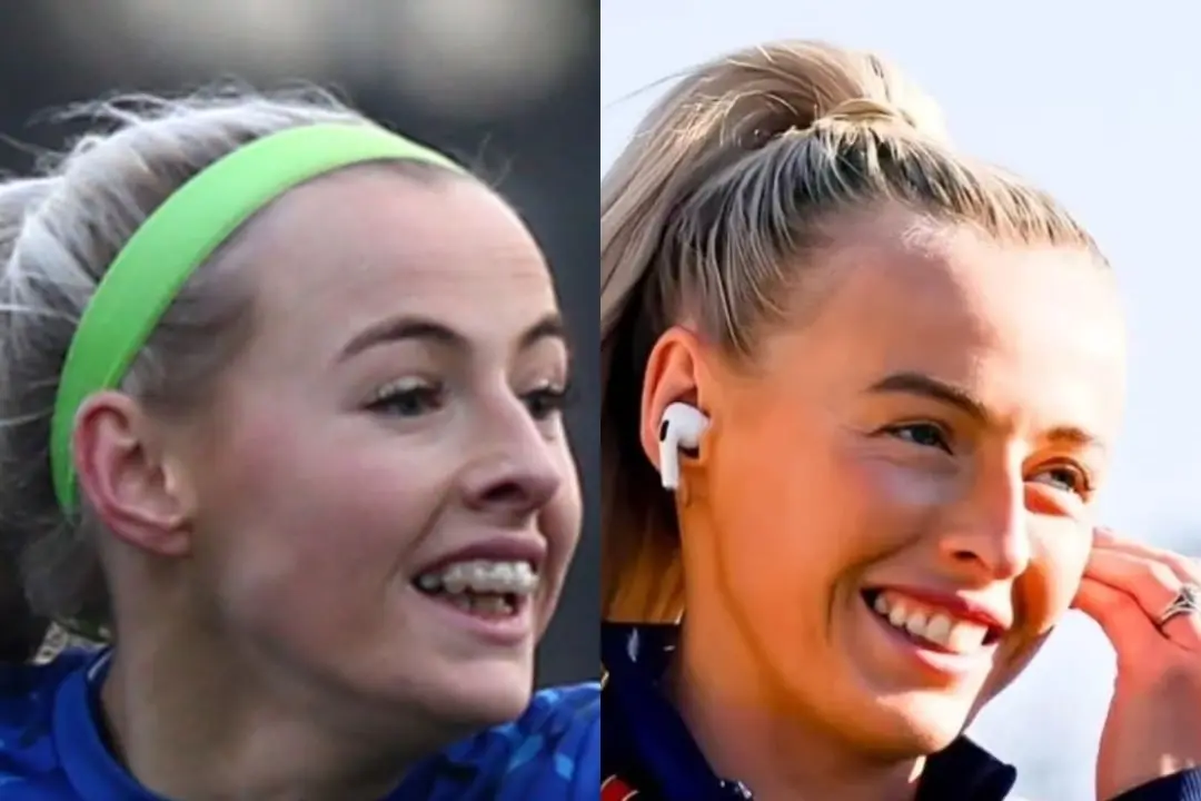 Chloe Kelly's teeth before and after