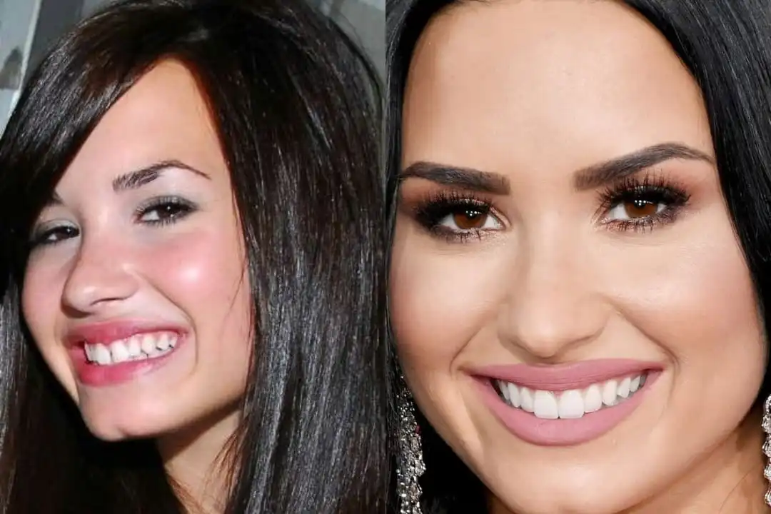 Demi Lovato teeth before after