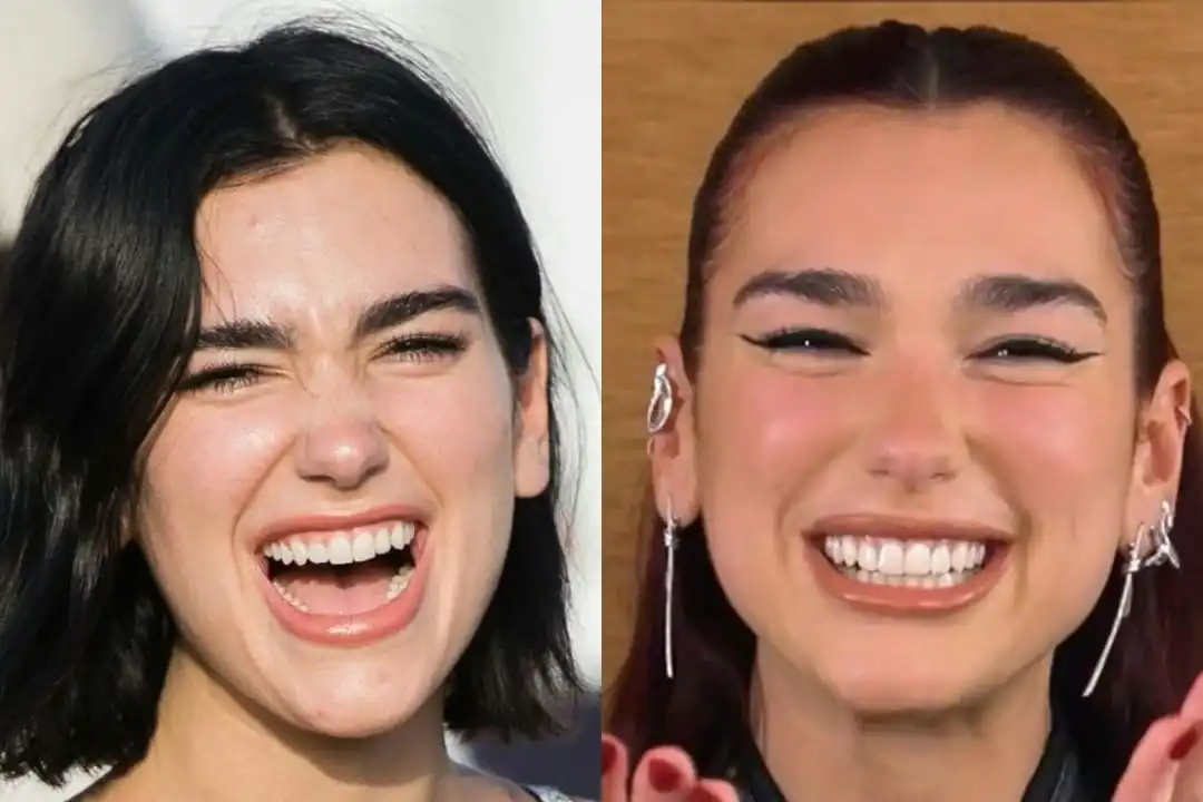 Dua Lipa teeth before after