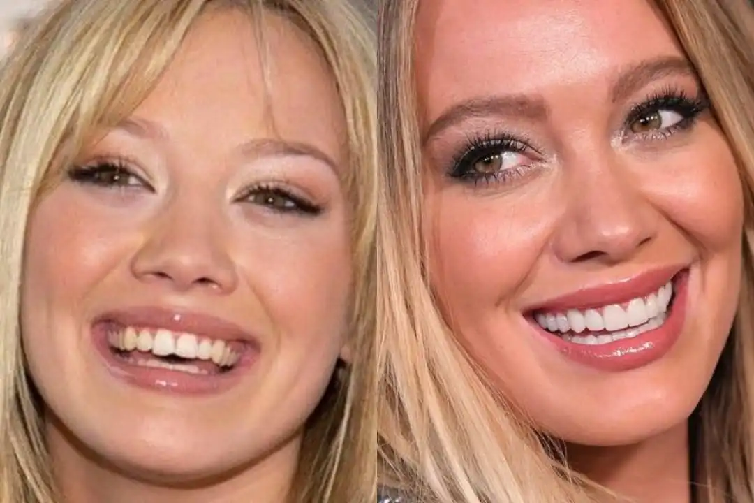 Hilary Duff teeth before after