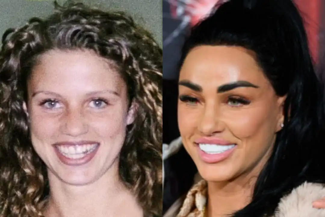Katie Price teeth before after