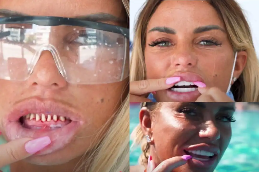 Katie Price porcelain veneers before after