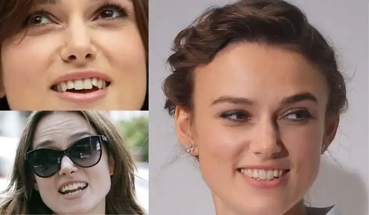 Keira Knightley teeth before and after