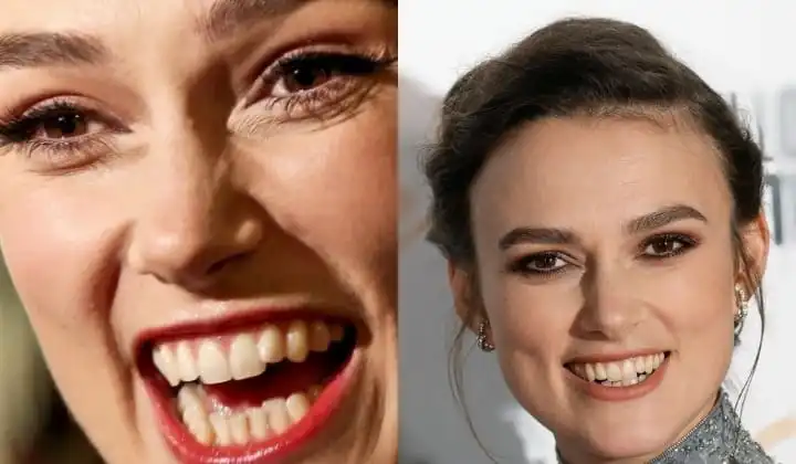 Keira Knightley teeth before and after