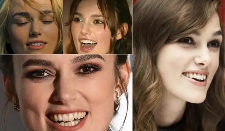Keira Knightley teeth before and after