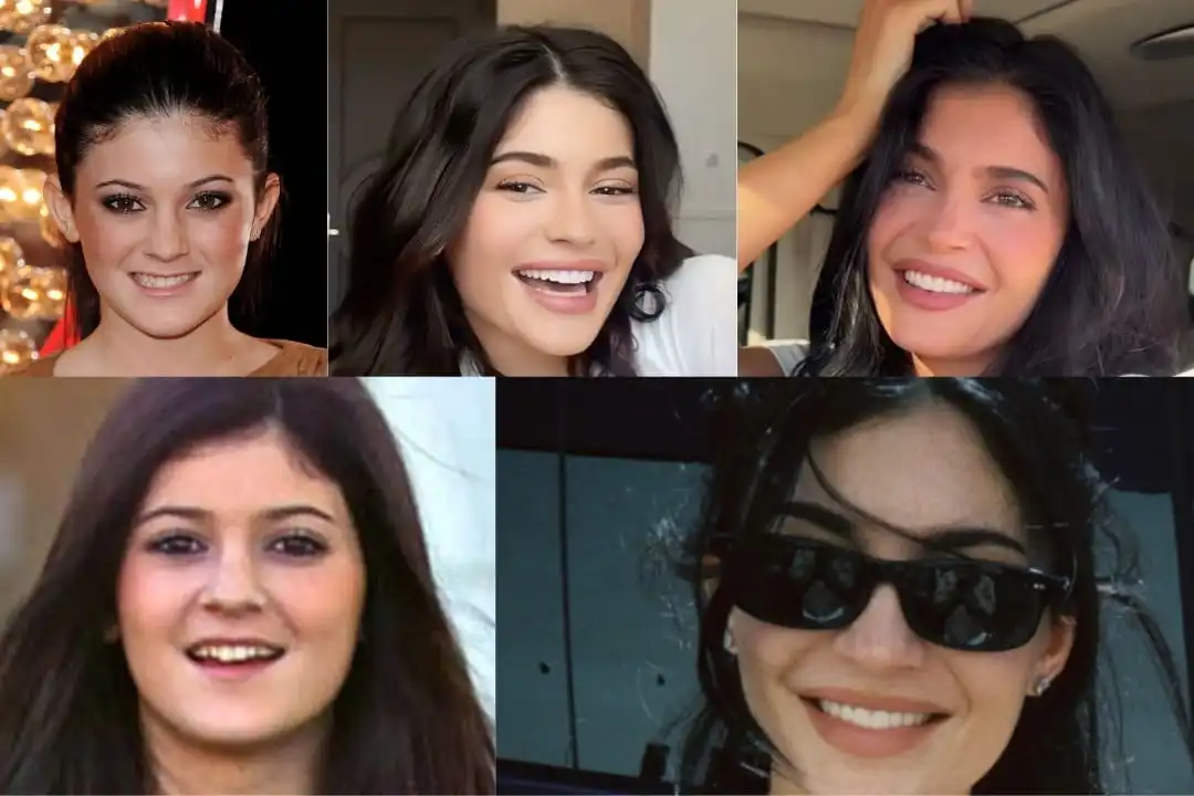 Kylie Jenner teeth before after