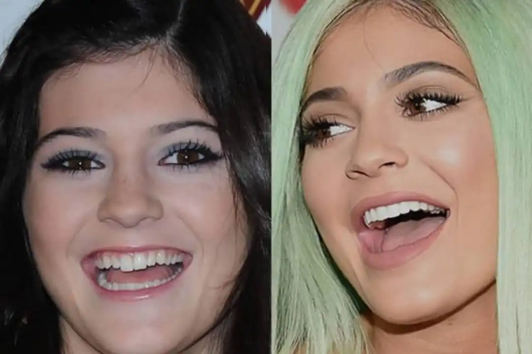 Kylie Jenner teeth before after