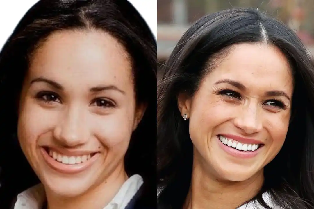 Meghan Markle teeth before after
