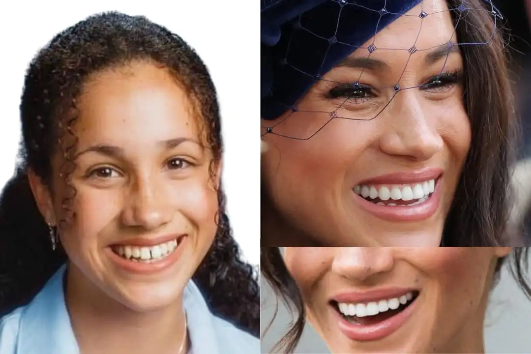 Meghan Markle teeth before after