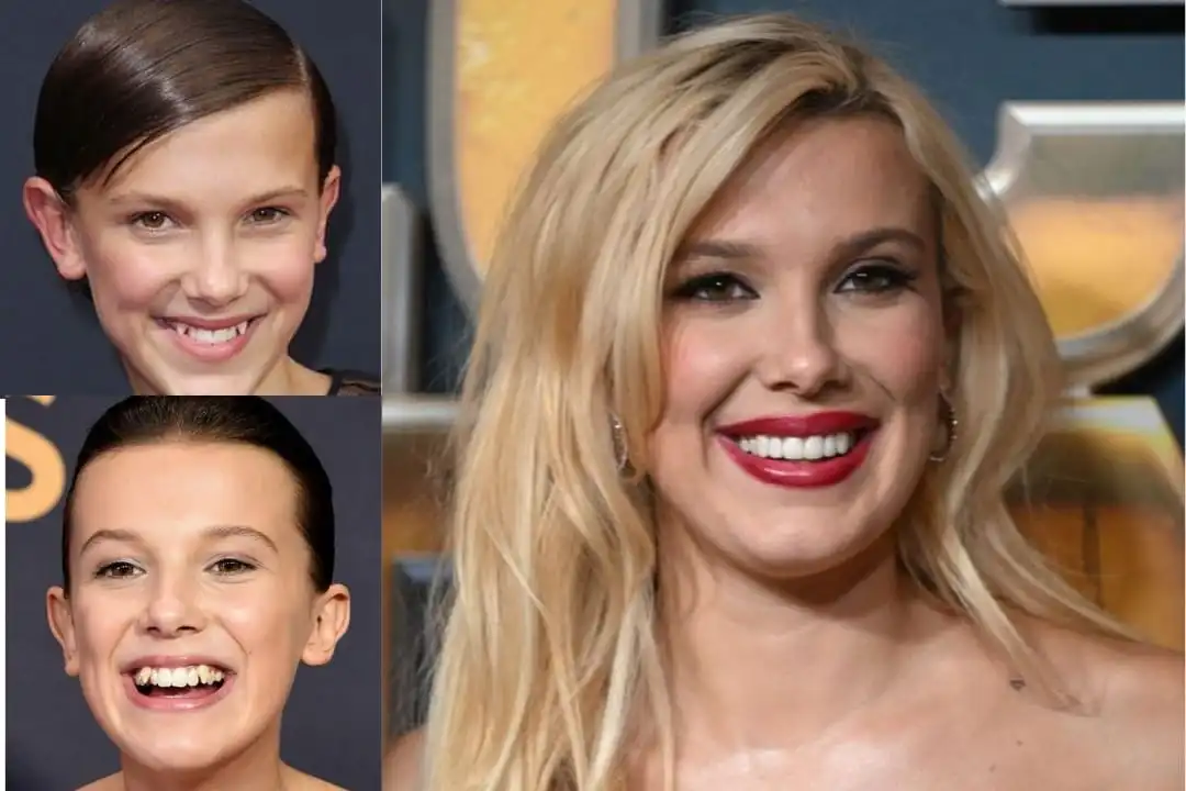 Millie Bobby Brown teeth before after