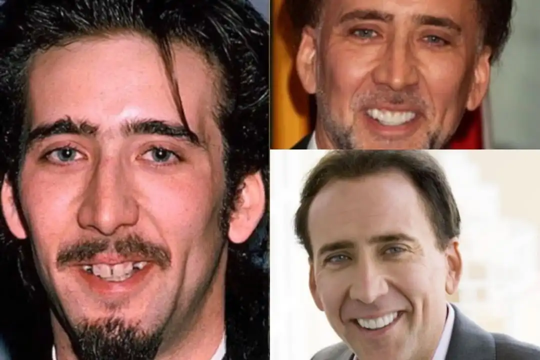 Nicolas Cage teeth veneer before after
