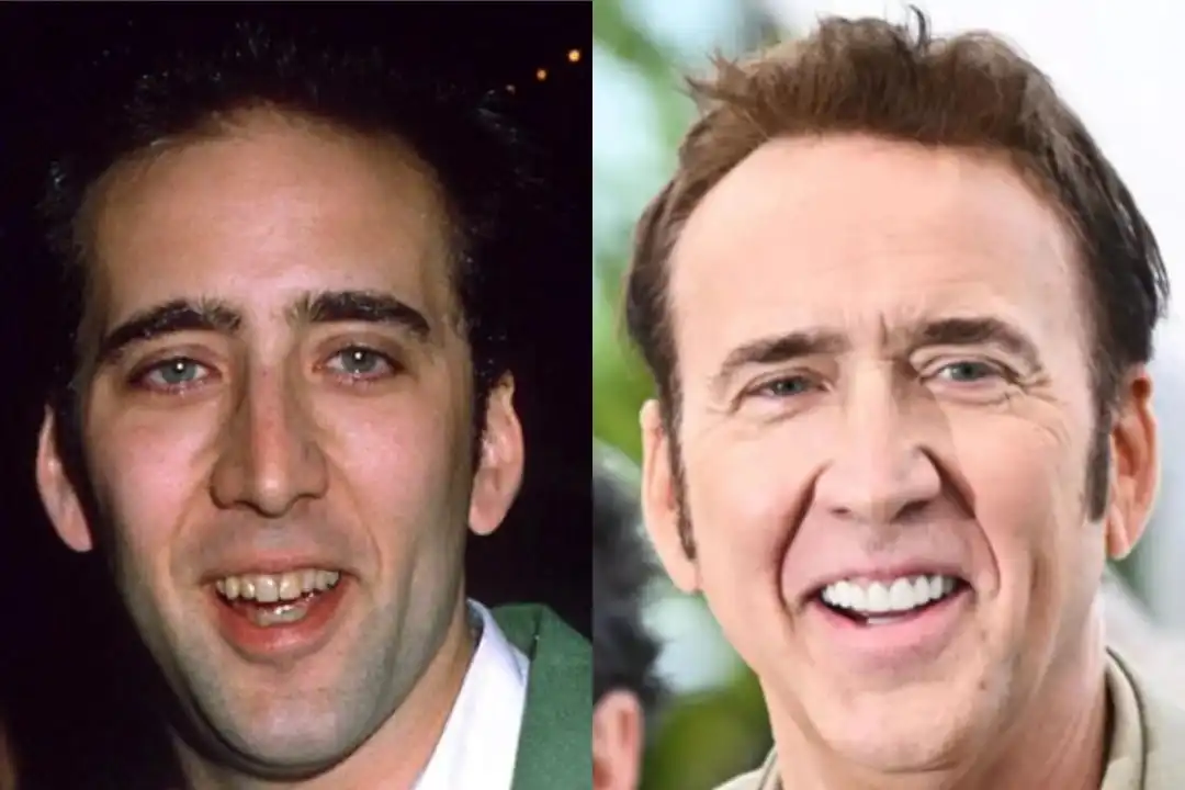 Nicolas Cage teeth before after