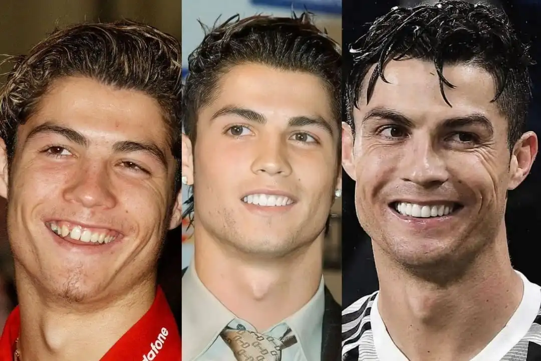 Christiano Ronaldo teeth before after
