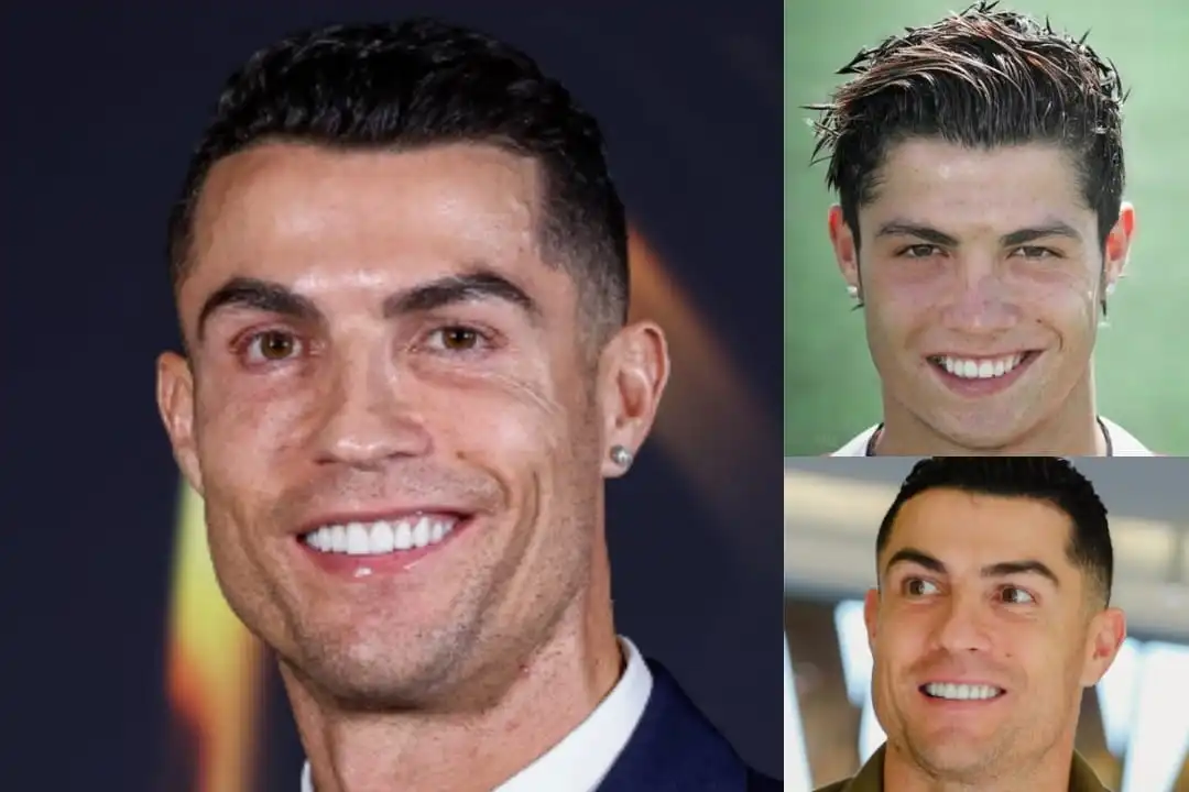 Christiano Ronaldo teeth before after