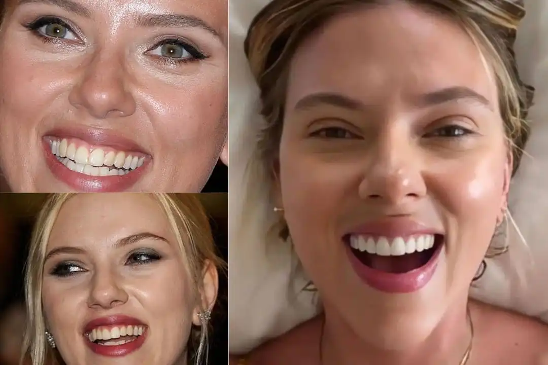 Millie Bobby Brown teeth before after