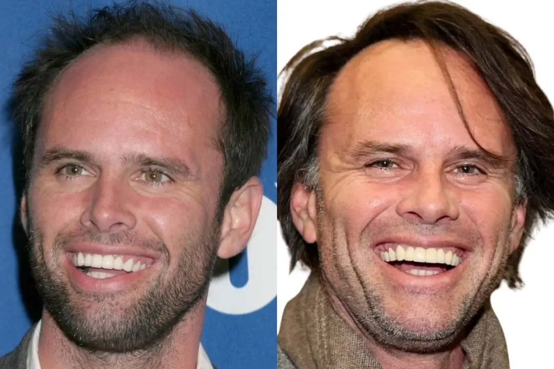 Walton Goggins teeth before and after