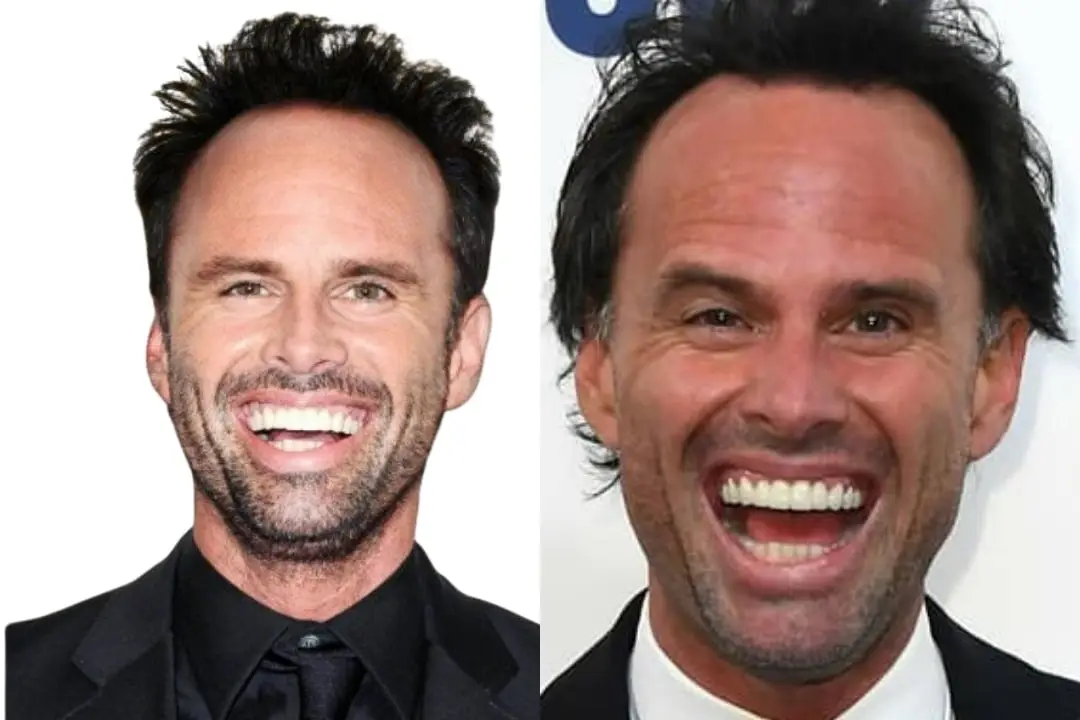 Walton Goggins teeth before and after