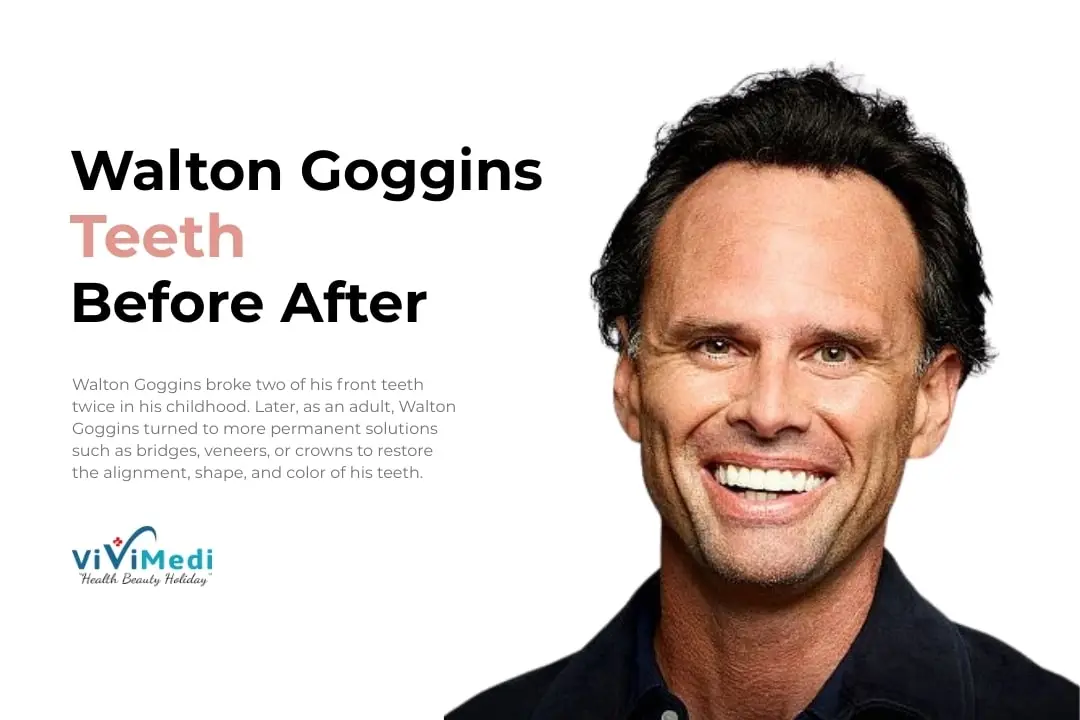Walton Goggins Teeth Before After