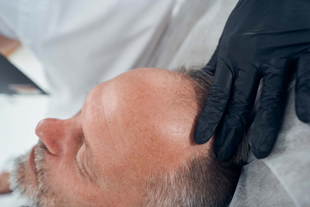 Direct Hair Implantation in Turkey