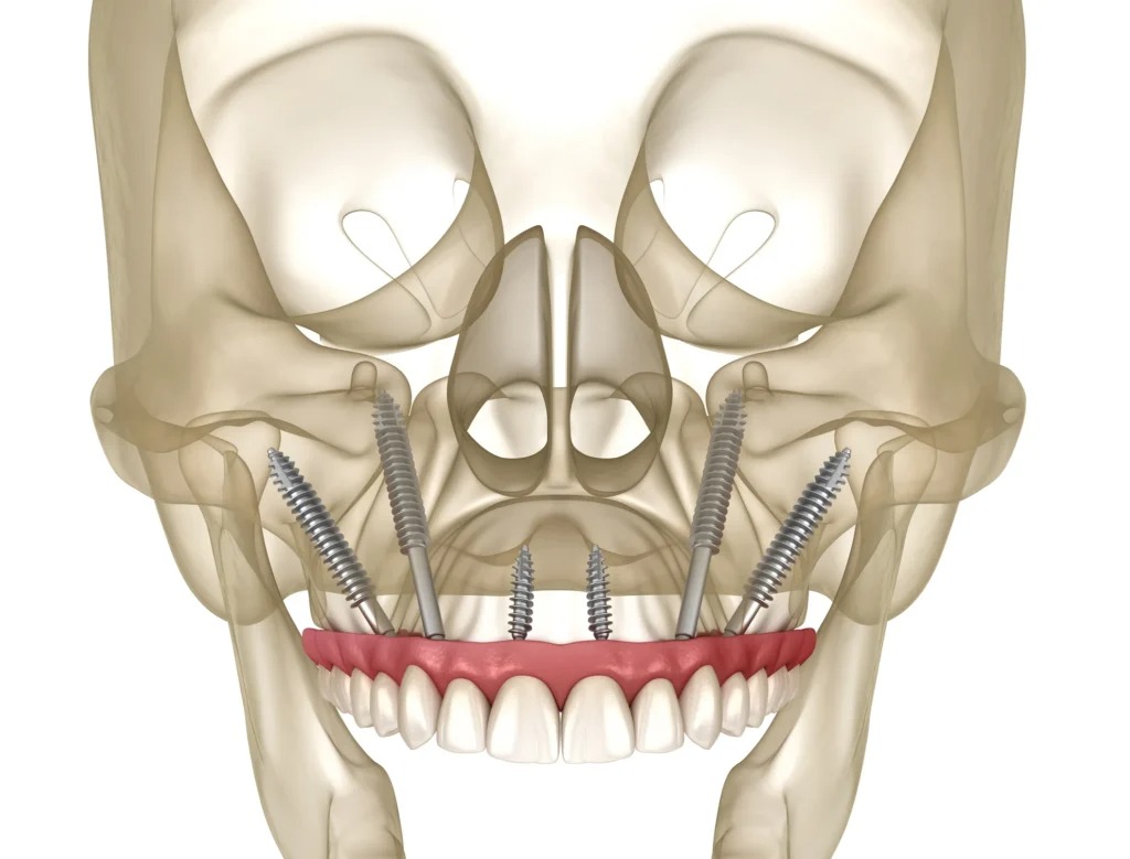 Zygomatic implants in Antalya, Turkey