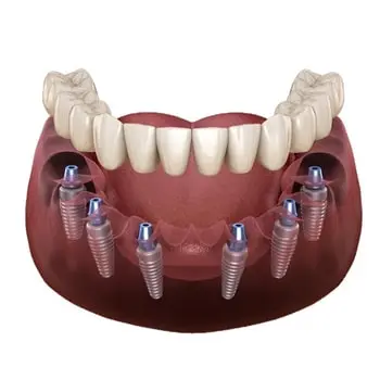 All on 6 implants Turkey Antalya