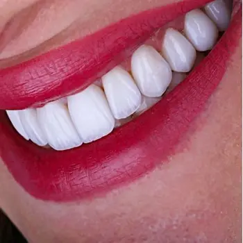 Emax Veneers