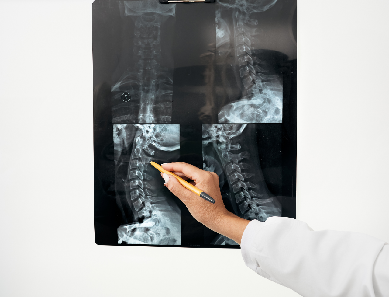 Spinal fusion Treatment Antalya Turkey