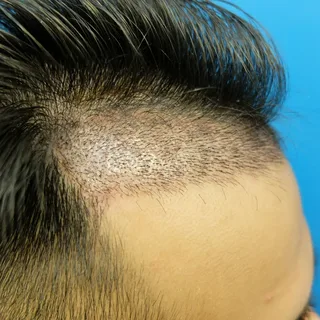 FUE-Haartransplantation