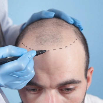DHI vs. FUE: Choosing the Right Hair Transplant Technique for You