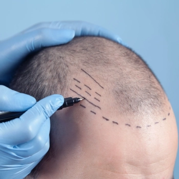 DHI vs. Traditional Hair Transplants Pros and Cons Unveiled