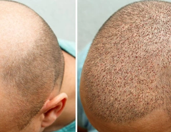 Understanding Different Hair Transplant Techniques: Which is Right for You?