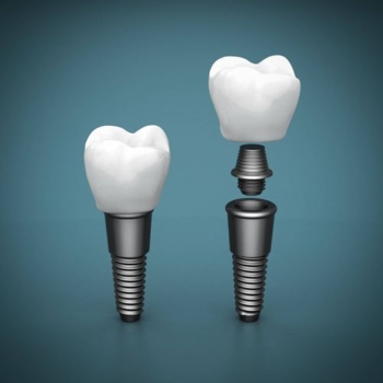Major Advantages of Dental Implant in Antalya, Turkey