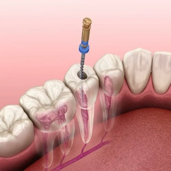 Beyond the Surface: Understanding the Importance of Root Canal Treatment