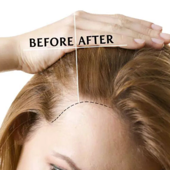 Advantages of Hair Transplant for Woman in Turkey