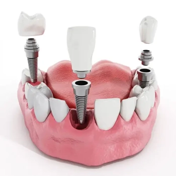 Building Bridges: The Role of Bone Augmentation in Dental Implants