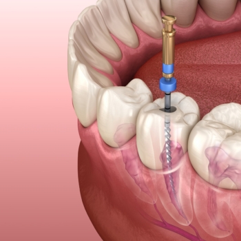 Root canal treatment cost in Turkey