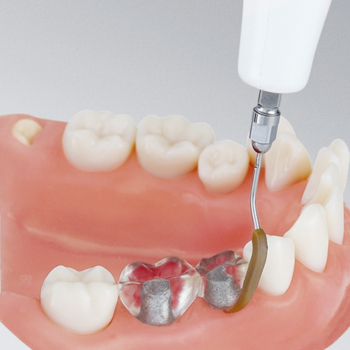 Root canal treatment for cracked tooth in Turkey