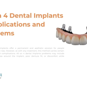 all-on-4-implants-complications-and-problems