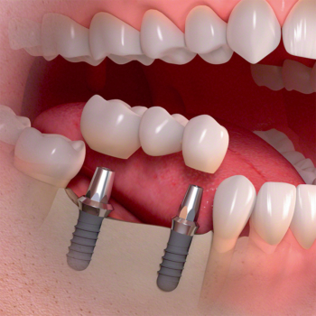 Experienced dental implant specialists Antalya