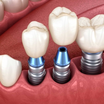 Trusted dental implant experts Antalya Turkey