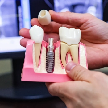 Painless dental implant procedures Antalya