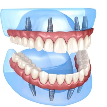 The Future of Dental Implants: Innovations on the Horizon